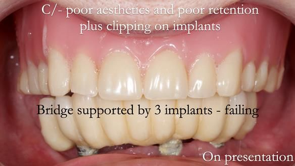 Newsletter 49 Managing Estelle’s failing implants with dentures FULL PROTOCOL