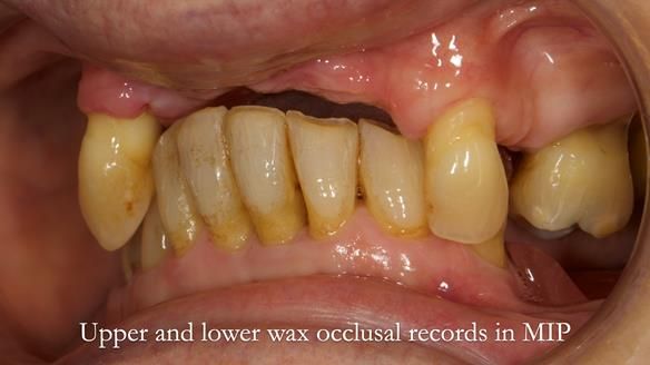 Newsletter 71 Jean’s Class I Mod III RPD: See my mistakes Fractured Mk1 to a Stronger Mk2 RPD (4 years on)