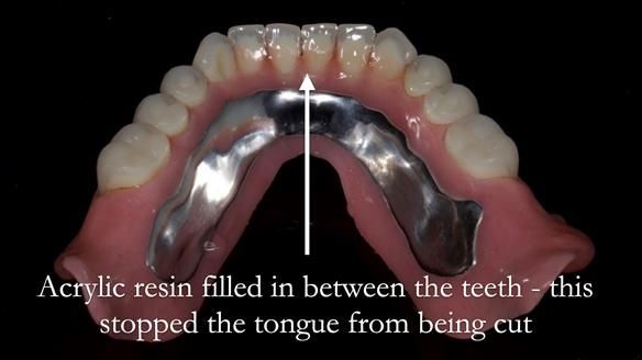 Newsletter 70 Complete Denture Treatment for Kate: A Case Study on Natural-Looking Dentures and Implant-Supported Overdentures