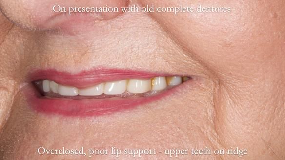 Newsletter 68 Restoring Jan’s Smile: Complete Dentures Inspired by Her Daughter’s Teeth - Post Mouth Surgery