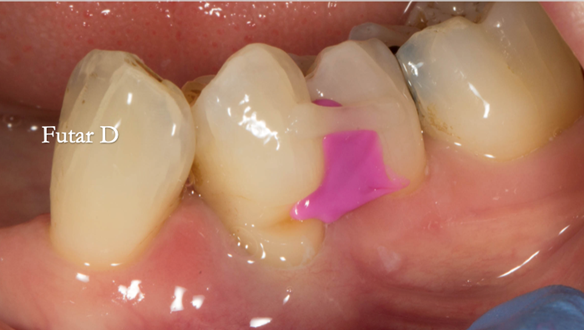 Figure 62 Grade 2 mobile LR4 would move in the impression. To avoid this it was temporarily stabilised with a composite splint and Futar D blocked out underneath to prevent impression tearing