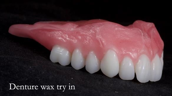 Newsletter 65 Marisa Provision of Complete Dentures on badly placed implants