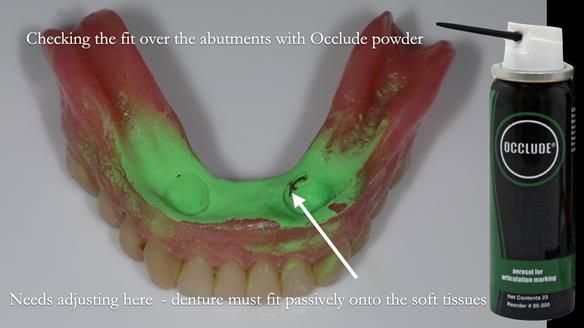 Newsletter 70 Complete Denture Treatment for Kate: A Case Study on Natural-Looking Dentures and Implant-Supported Overdentures