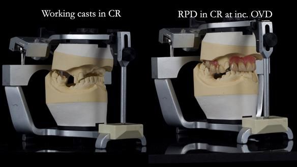 How Keith’s combat denture transformed his life – Newsletter 73