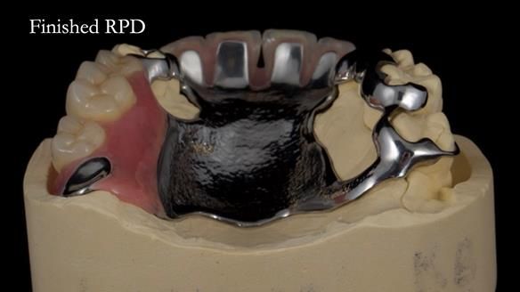 How Keith’s combat denture transformed his life – Newsletter 73