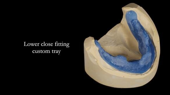 Newsletter 68 Restoring Jan’s Smile: Complete Dentures Inspired by Her Daughter’s Teeth - Post Mouth Surgery