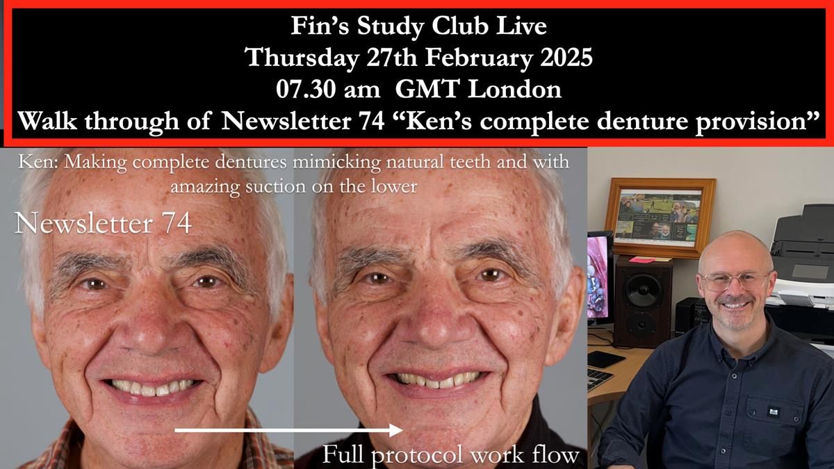 Fin’s Study Club Live – A walk-through of Newsletter 74: Ken’s complete denture provision. Demonstrating how to achieve exceptional lower suction with complete dentures. Click on this link at 7.30 am GMT on February 27th to join: https://us02web.zoom.us/