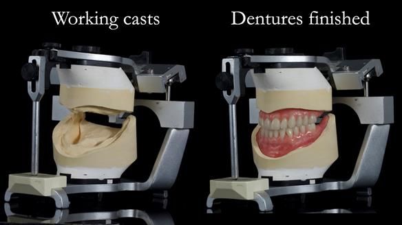 Newsletter 68 Restoring Jan’s Smile: Complete Dentures Inspired by Her Daughter’s Teeth - Post Mouth Surgery