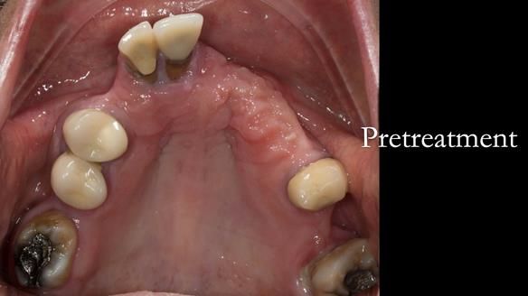 Eileen's transformation with upper and lower RPDs of Scandinavian hygienic design FULL PROTOCOL