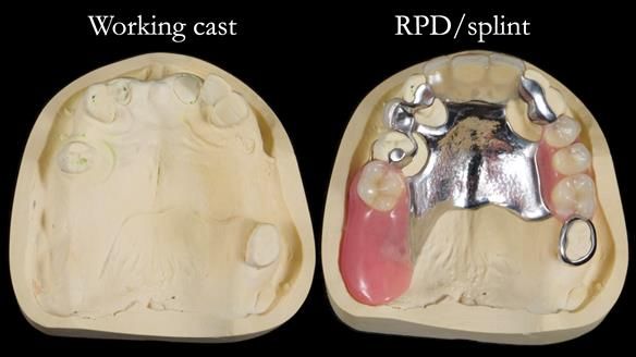 Managing Edgar “THE SCEPTIC” with an RPD/Splint FULL CASE