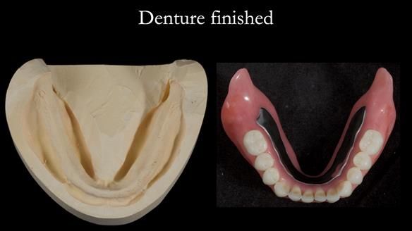 Newsletter 70 Complete Denture Treatment for Kate: A Case Study on Natural-Looking Dentures and Implant-Supported Overdentures