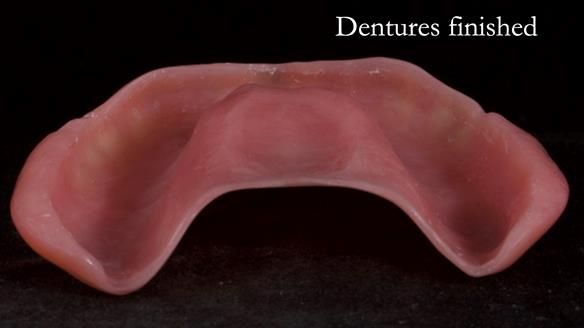 Newsletter 70 Complete Denture Treatment for Kate: A Case Study on Natural-Looking Dentures and Implant-Supported Overdentures