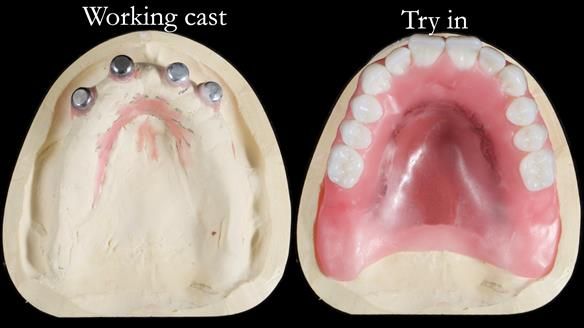 Newsletter 65 Marisa Provision of Complete Dentures on badly placed implants