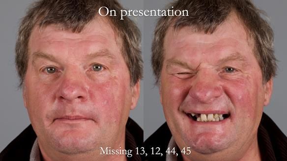 Read Newsletter 67 - Brian's COMBAT DENTURE Case Study