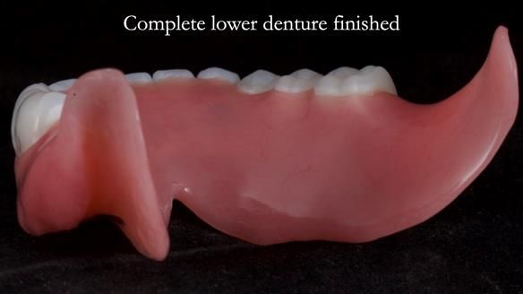 Newsletter 65 Marisa Provision of Complete Dentures on badly placed implants