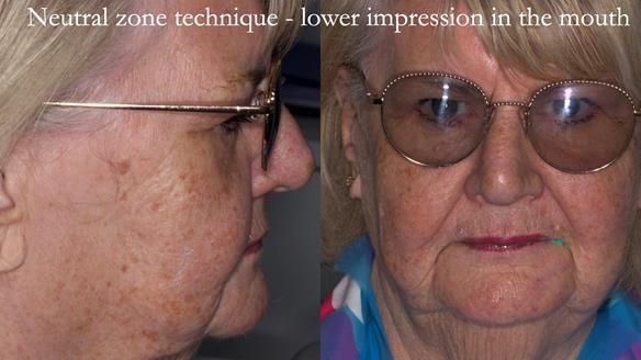 Replacing Madeline’s Complete denture FULL PROTOCOL