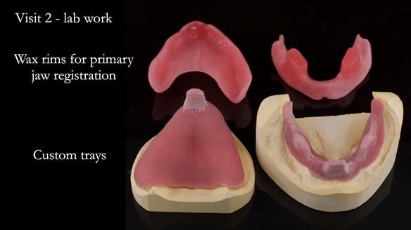 Newsletter 74: Ken’s Case Study Complete Dentures - Life Like and Age Appropriate