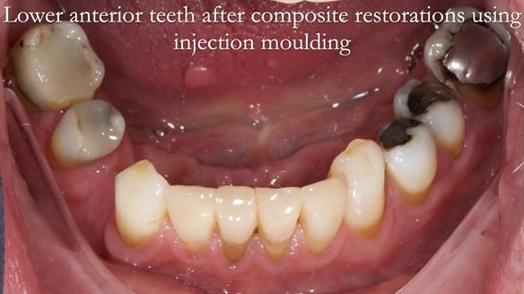 Read Newsletter 67 - Brian's COMBAT DENTURE Case Study