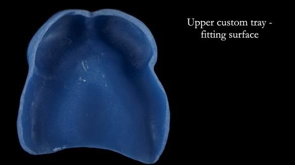 Newsletter 65 Marisa Provision of Complete Dentures on badly placed implants