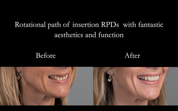  Figure 85 Before and after photos with cobalt chromium based partial dentures with Schottlander Enigmalife teeth