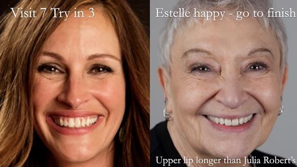 Newsletter 49 Managing Estelle’s failing implants with dentures FULL PROTOCOL