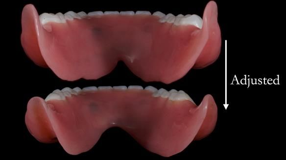 Newsletter 65 Marisa Provision of Complete Dentures on badly placed implants