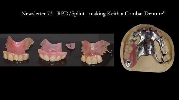 How Keith’s combat denture transformed his life – Newsletter 73