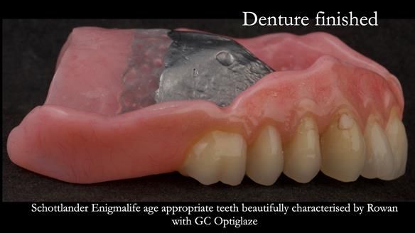 Newsletter 74: Ken’s Case Study Complete Dentures - Life Like and Age Appropriate