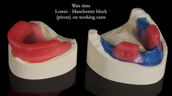 Newsletter 68 Restoring Jan’s Smile: Complete Dentures Inspired by Her Daughter’s Teeth - Post Mouth Surgery