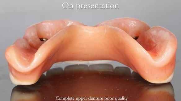 Newsletter 65 Marisa Provision of Complete Dentures on badly placed implants