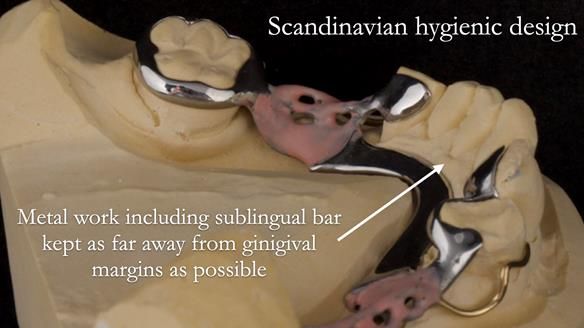 Eileen's transformation with upper and lower RPDs of Scandinavian hygienic design FULL PROTOCOL