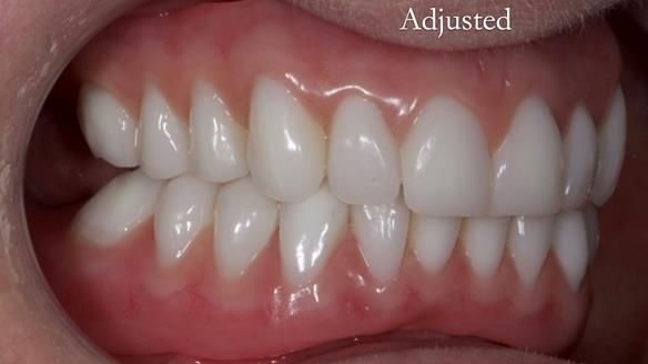 Newsletter 65 Marisa Provision of Complete Dentures on badly placed implants