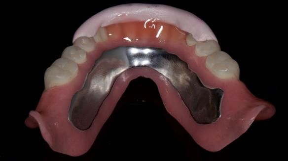 Newsletter 70 Complete Denture Treatment for Kate: A Case Study on Natural-Looking Dentures and Implant-Supported Overdentures