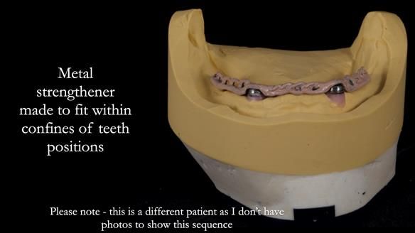 Newsletter 65 Marisa Provision of Complete Dentures on badly placed implants