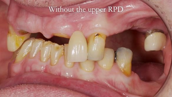 Managing Edgar “THE SCEPTIC” with an RPD/Splint FULL CASE