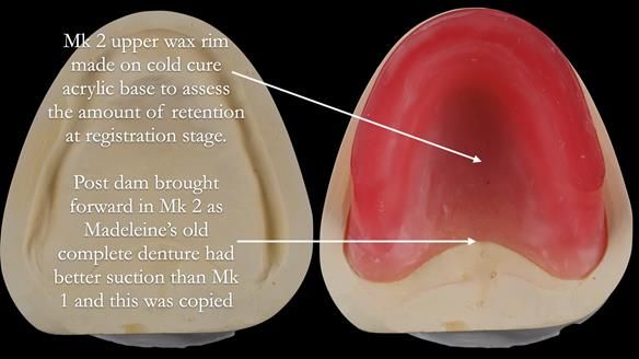 Replacing Madeline’s Complete denture FULL PROTOCOL