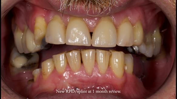 How Keith’s combat denture transformed his life – Newsletter 73