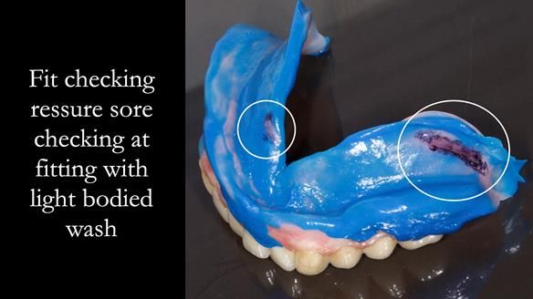 Newsletter 74: Ken’s Case Study Complete Dentures - Life Like and Age Appropriate