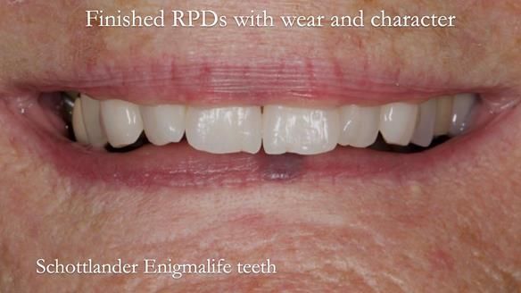 Eileen's transformation with upper and lower RPDs of Scandinavian hygienic design FULL PROTOCOL