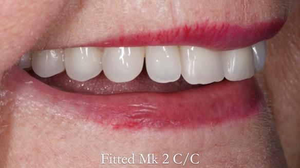 Replacing Madeline’s Complete denture FULL PROTOCOL