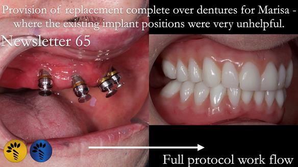 Newsletter 65 Marisa Provision of Complete Dentures on badly placed implants