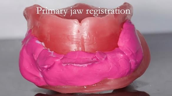 Replacing Madeline’s Complete denture FULL PROTOCOL