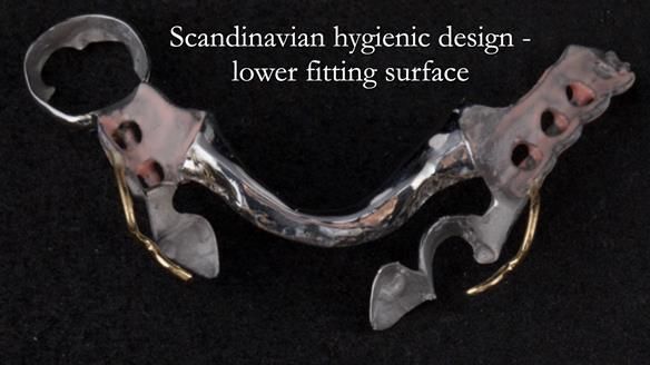 Eileen's transformation with upper and lower RPDs of Scandinavian hygienic design FULL PROTOCOL