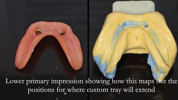 Newsletter 65 Marisa Provision of Complete Dentures on badly placed implants