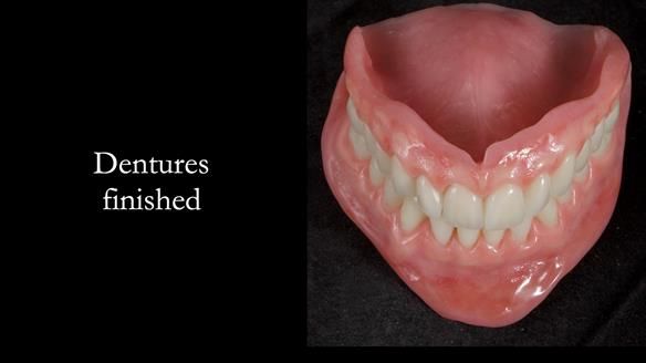 Newsletter 68 Restoring Jan’s Smile: Complete Dentures Inspired by Her Daughter’s Teeth - Post Mouth Surgery