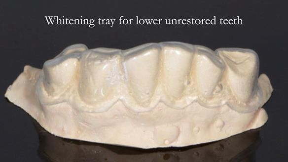 Eileen's transformation with upper and lower RPDs of Scandinavian hygienic design FULL PROTOCOL