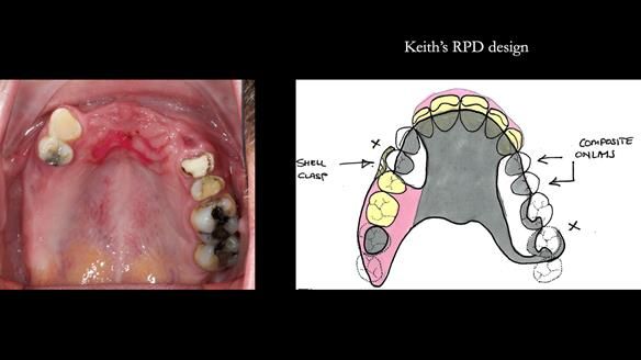 How Keith’s combat denture transformed his life – Newsletter 73