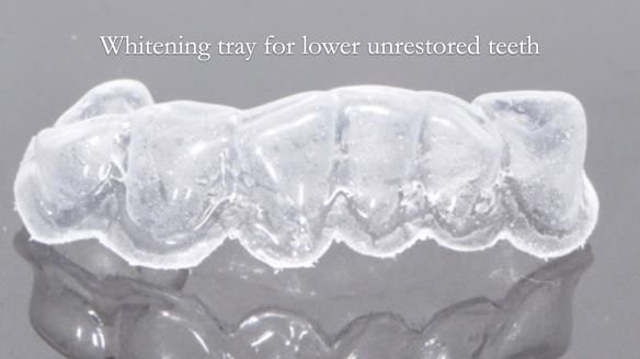 Eileen's transformation with upper and lower RPDs of Scandinavian hygienic design FULL PROTOCOL