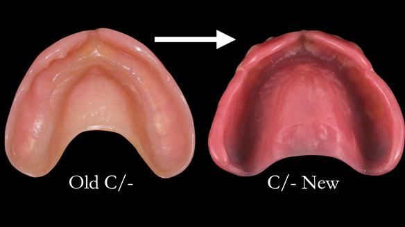 Newsletter 48 Mavis's Complete denture FULL PROTOCOL