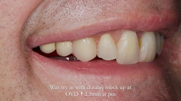 Read Newsletter 67 - Brian's COMBAT DENTURE Case Study